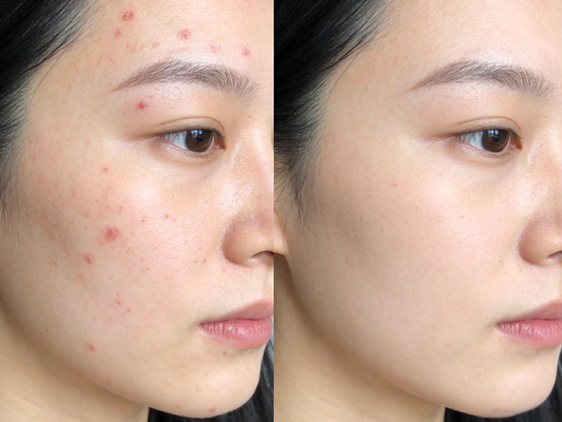 針清暗瘡正確手法｜不紅腫、不反彈、不留印｜美容初學必學