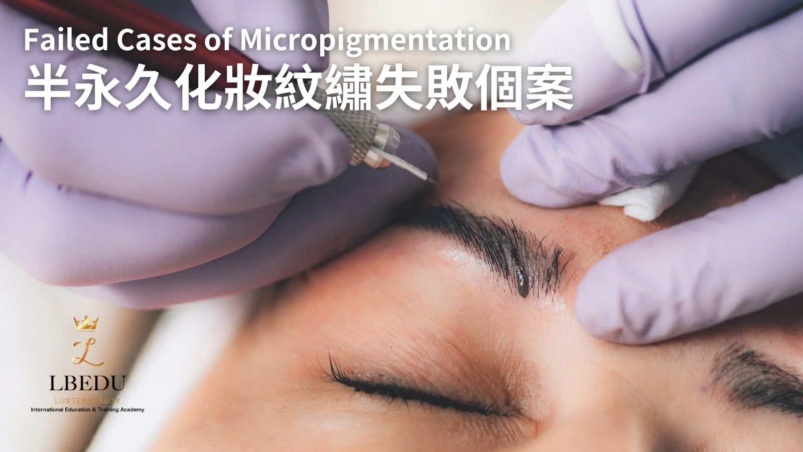 Failed Case of Micropigmentation 
